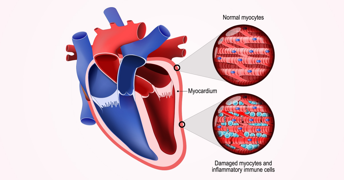 กล้ามเนื้อหัวใจอักเสบ รู้ระวังอย่ามองข้าม