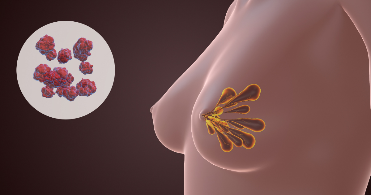 Augment new breast with tissue, increase confidence after cancer surgery