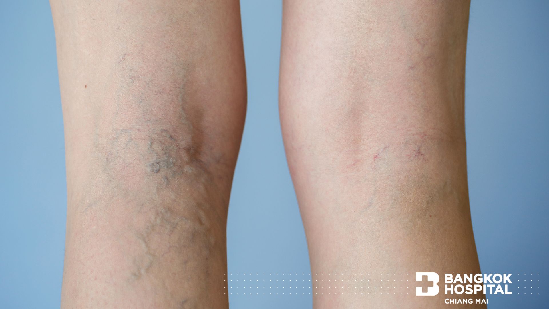 Varicose Veins Bangkok Hospital Chiang Mai