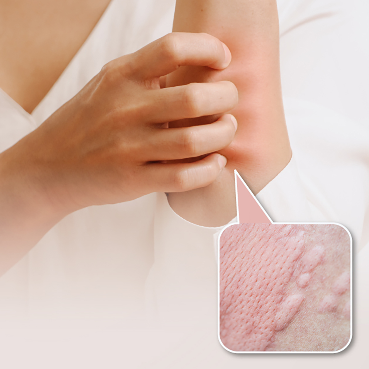 แพ็กเกจตรวจค้นหาโรคลมพิษเรื้อรัง (Chronic Urticaria)