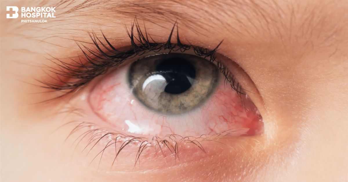 Preventing Conjunctivitis (Pink Eye)