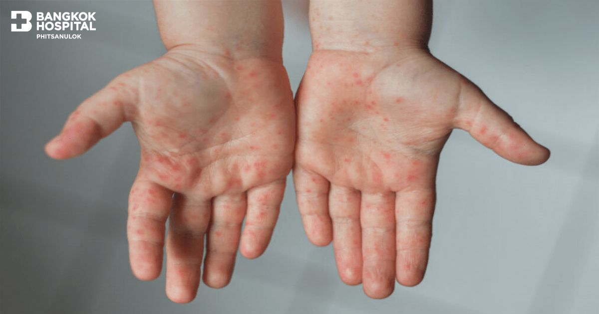 Hand, Foot and Mouth Disease (HFMD)