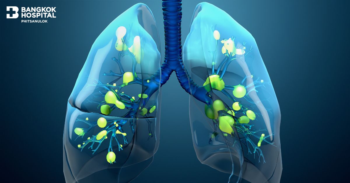 Pneumonia – A Silent Threat Not to Be Overlooked