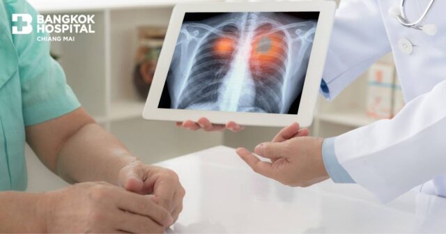 Lung Cancer: Causes, Symptoms, Diagnosis and Treatment Image