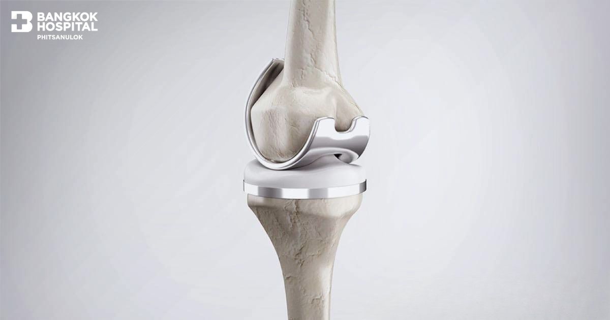 Minimally Invasive Knee Replacement Surgery in Phitsanulok