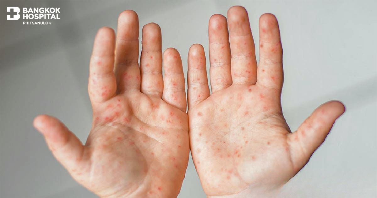 โรคมือ เท้า ปาก