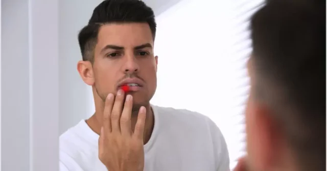 วิธีบรรเทาอาการร้อนในหรือแผลในปากด้วยตัวเอง Image