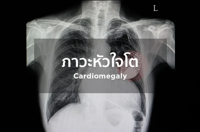 หัวใจโต (Cardiomegaly) Image