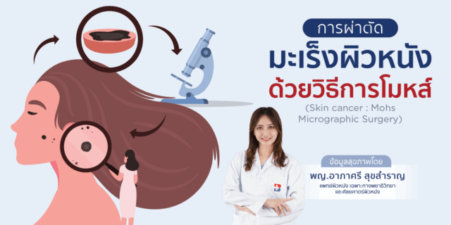 การผ่าตัดมะเร็งผิวหนังด้วยวิธีการโมหส์ (Skin cancer : Mohs Micrographic Surgery) Image