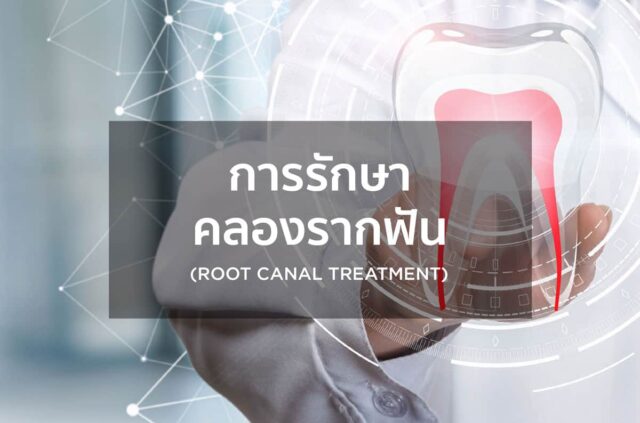 การรักษาคลองรากฟัน Image