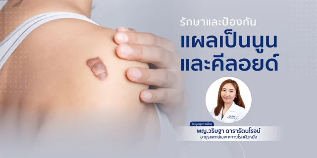 รักษาและป้องกัน แผลเป็นนูนและคีลอยด์