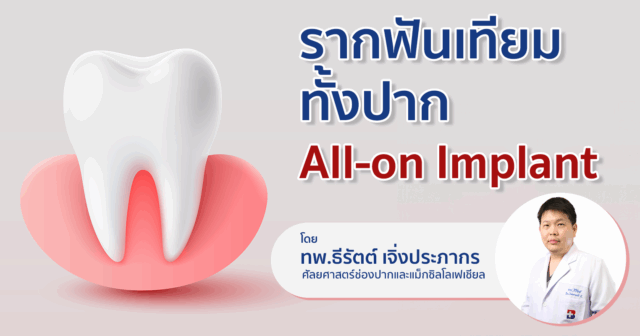 เจาะลึก "รากฟันเทียม" และนวัตกรรม "All-on Implant" Image