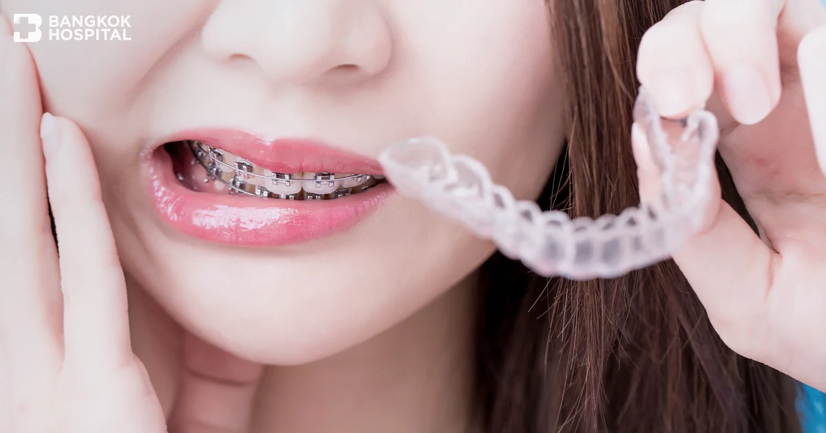 Invisalign Debonding 解决了牙齿矫正金属问题,无需重新开始计数。