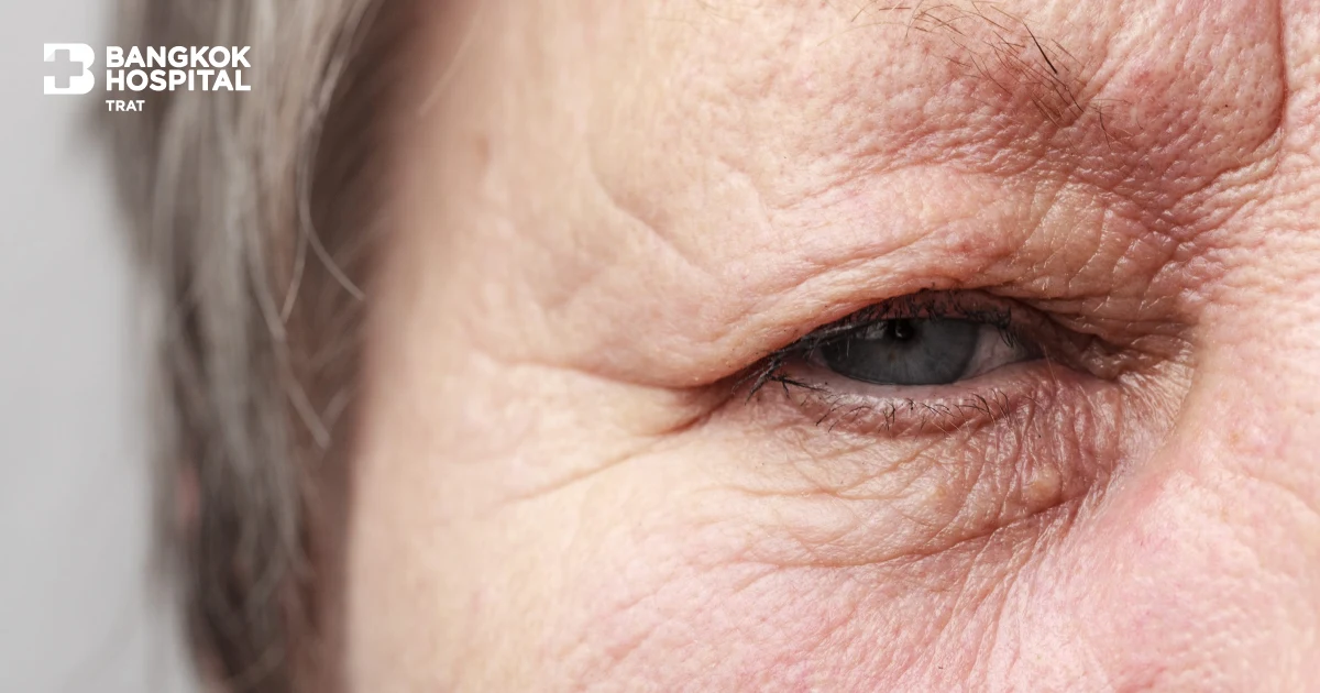 Sub Brow Lift | Correct Droopy Eyelids
