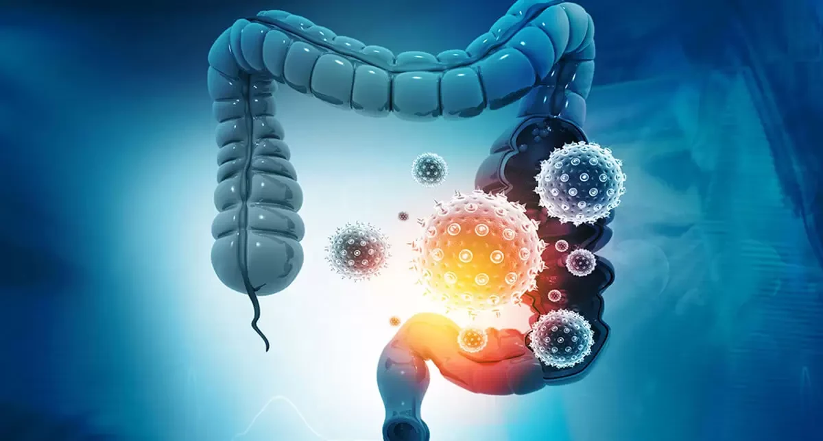 Colon Cancer