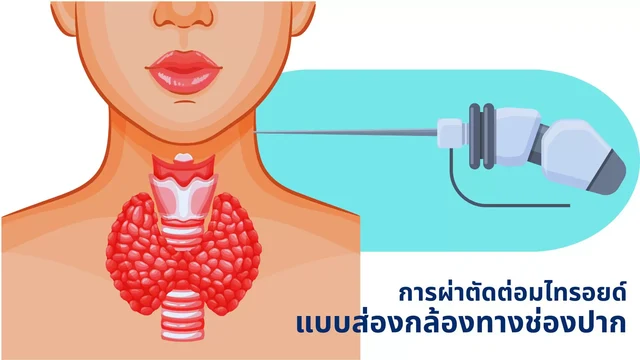 สิ่งที่ต้องรู้ก่อนและหลังการผ่าตัดต่อมไทรอยด์ส่องกล้องทางช่องปาก