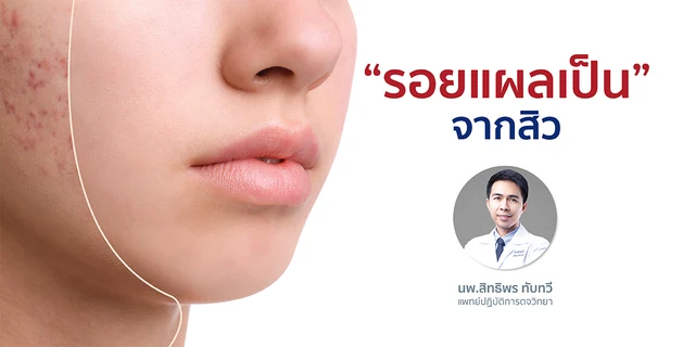 “รอยแผลเป็น”จากสิว