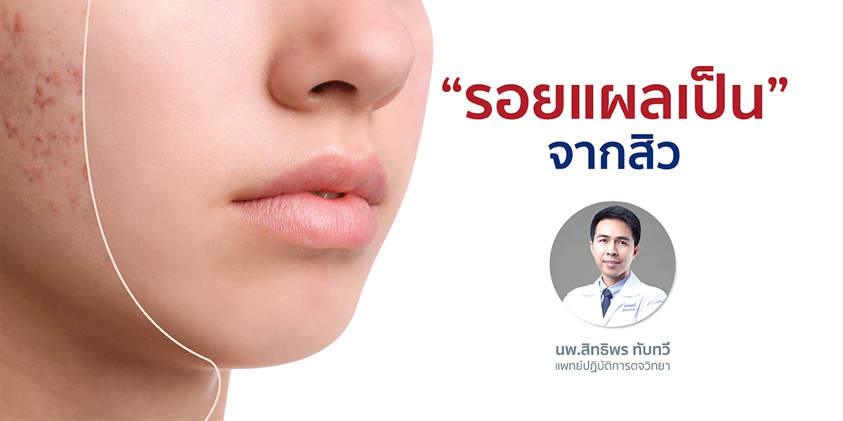 “รอยแผลเป็น”จากสิว