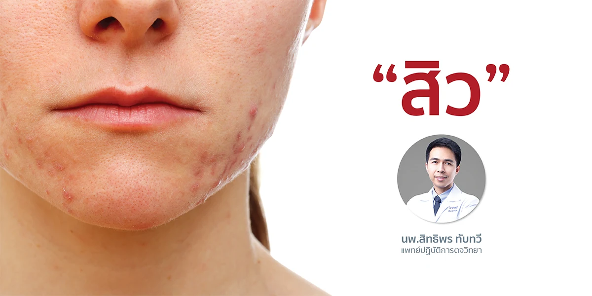 "สิว"