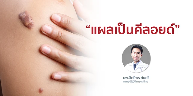 “แผลเป็นคีลอยด์”