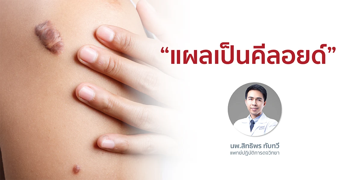 “แผลเป็นคีลอยด์”