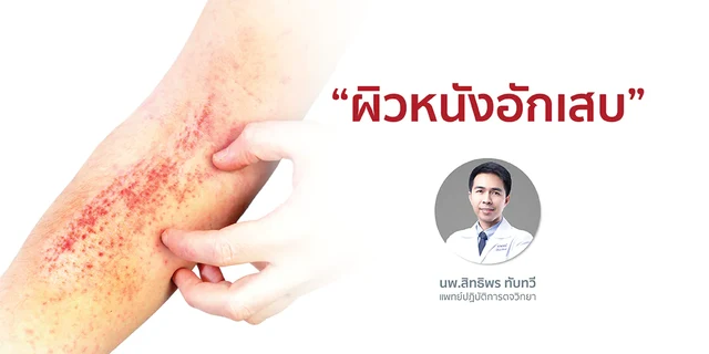 “ผิวหนังอักเสบ”