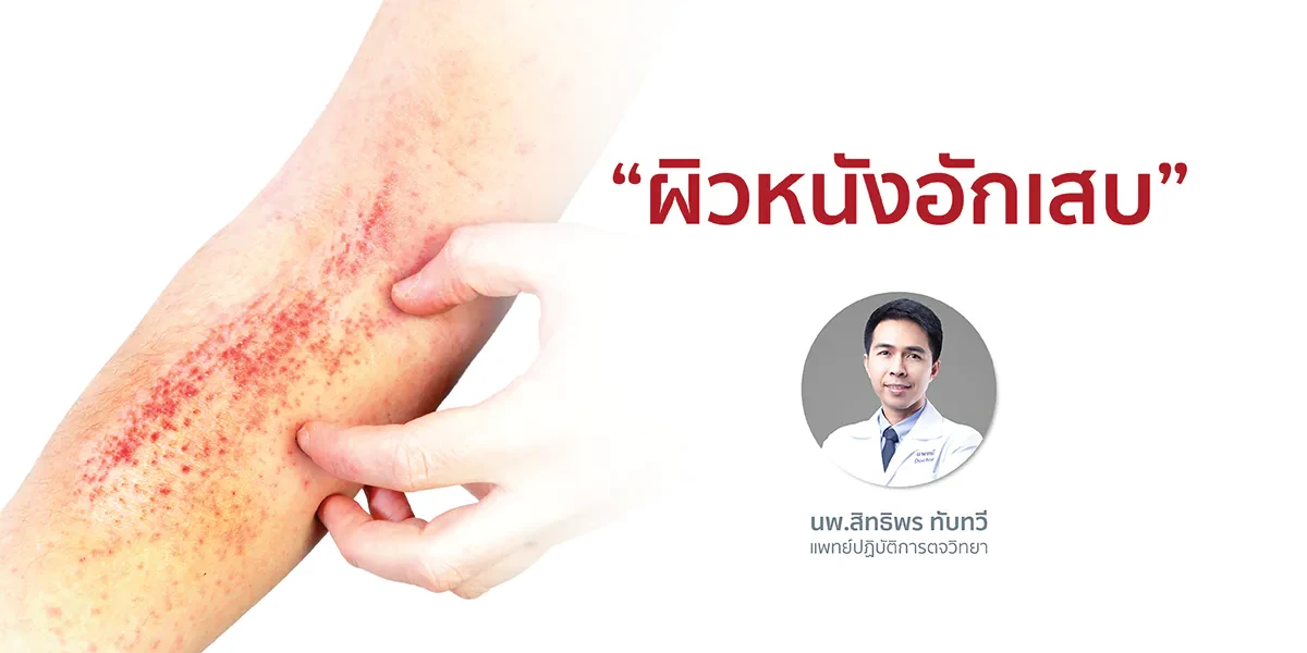 “ผิวหนังอักเสบ”