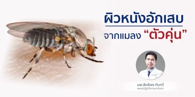 ผิวหนังอักเสบ จากแมลง “ตัวคุ่น”