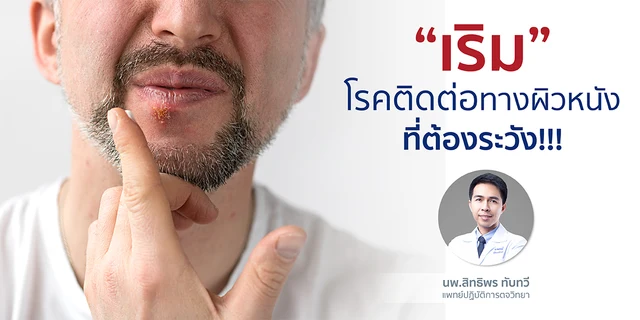 “เริม” โรคติดต่อทางผิวหนัง ที่ต้องระวัง!!!