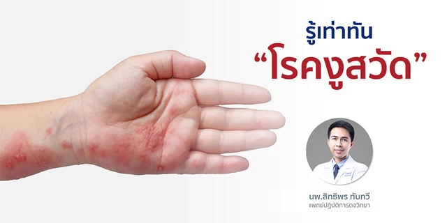 รู้เท่าทัน "โรคงูสวัด"