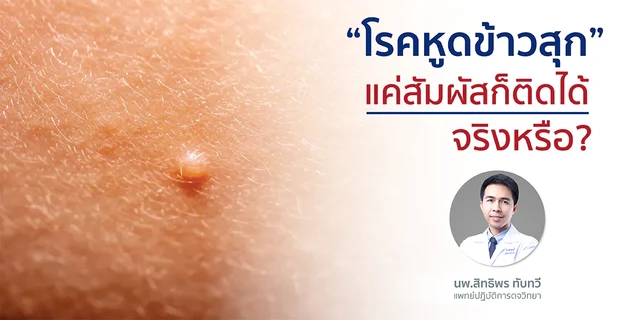 “โรคหูดข้าวสุก” แค่สัมผัสก็ติดได้ จริงหรือ?