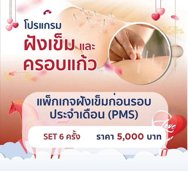 แพ็กเกจฝังเข็มก่อนรอบประจำเดือน(PMS) 6 ครั้ง