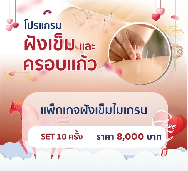 แพ็กเกจฝังเข็มไมเกรน 10 ครั้ง